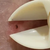 Tick Nipper